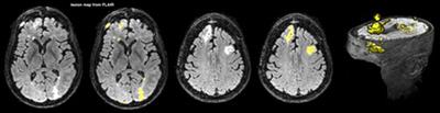 Analytic Tools for Post-traumatic Epileptogenesis Biomarker Search in Multimodal Dataset of an Animal Model and Human Patients